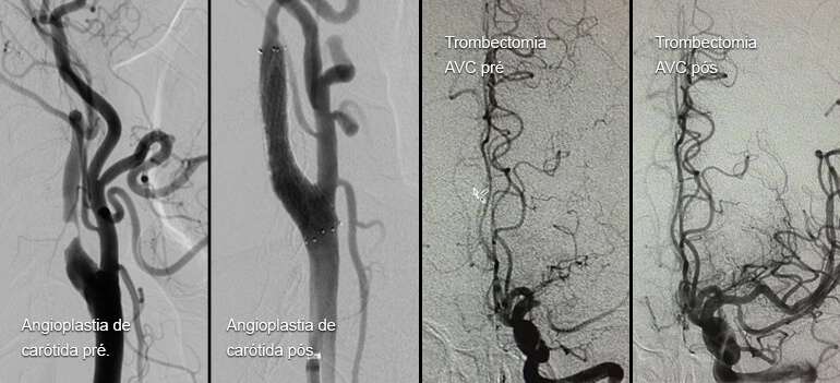 Angiografia cerebral