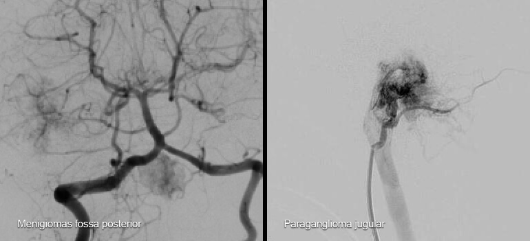 Tumores cervicais e intracranianos