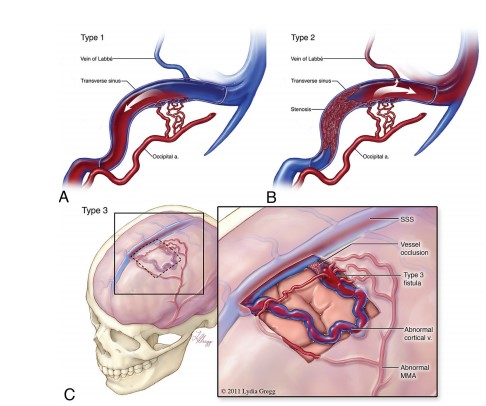 Discussão de tratamento de Fístula Arteriovenosa Dural grau I